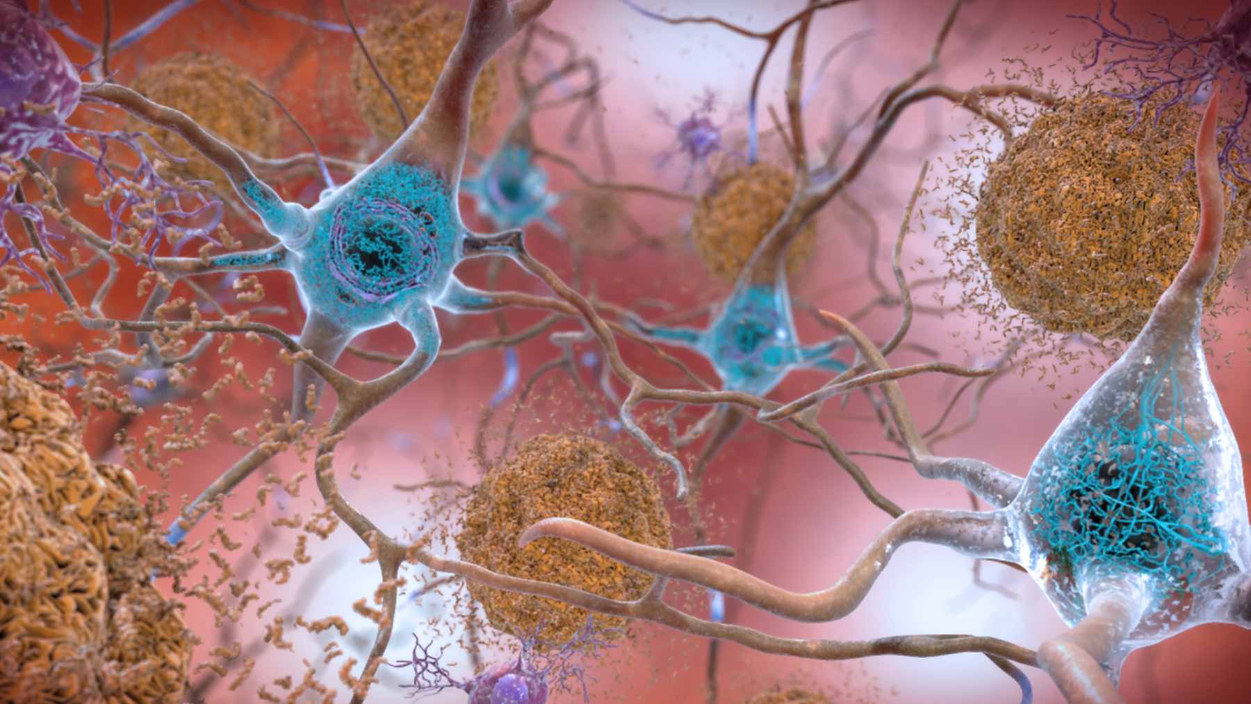 A microscopic view of star-shaped astrocyte cells in the brain interacting with amyloid plaques.