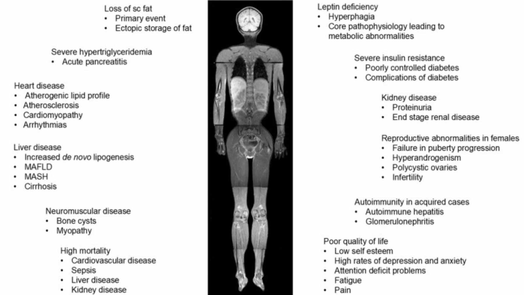 A medical diagram showing the systemic effects of lipodystrophy, including leptin deficiency and insulin resistance.
