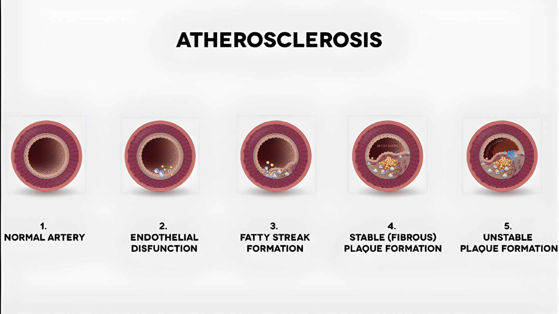 A medical illustration showing a cross-section of a healthy artery compared to one narrowed by fatty plaque buildup.